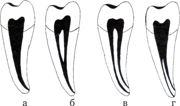 Типы корневых каналов в однокорневых зубах